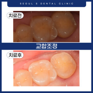 0 교합조정썸네일