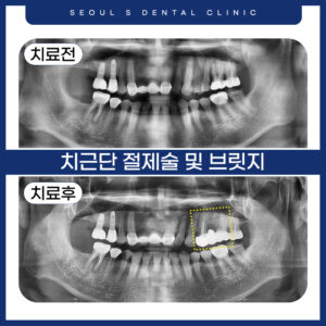 00 치근단절제술 전후사진