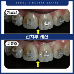 전치부 레진수복 전후