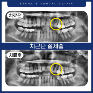 0.썸넬
