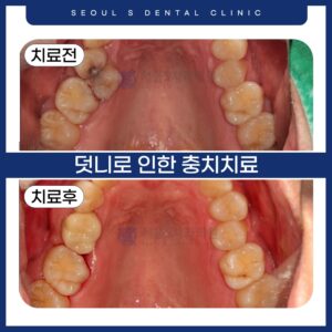 산본충치치료