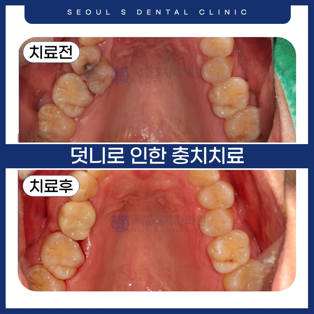 산본충치치료